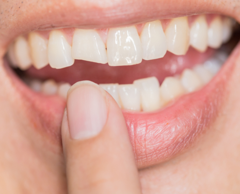 Zahnverschiebung bei Erwachsenen: Ursachen und Behandlung